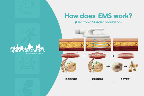 EMS treatment for post pregnancy weight loss treatment Welford on Avon