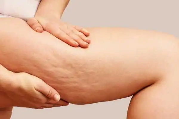 Image of woman showing leg with cellulite Welford on Avon