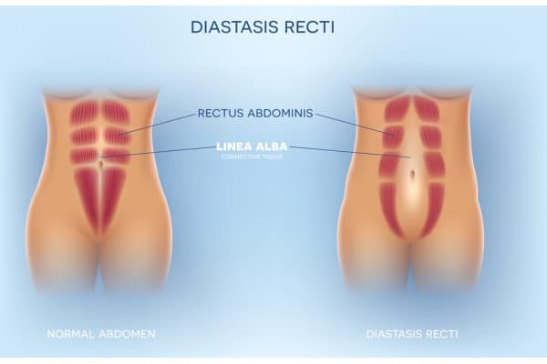 What Non-Surgical Options Are Available for Diastasis Recti Welford on Avon?