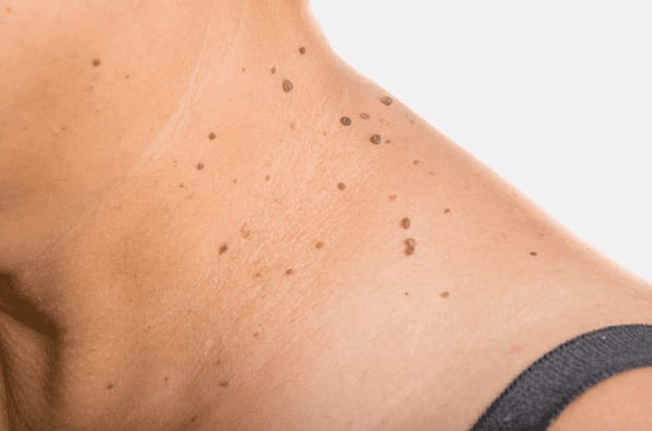 Are you looking for easy skin tag removal Welford on Avon - then contact Spire today!
