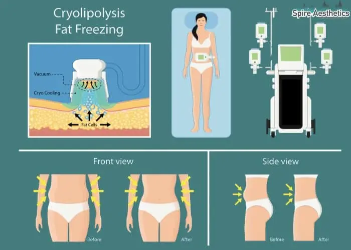 Fat freezing treatment Welford on Avon benefits for competitions to remove stubborn fat deposits.