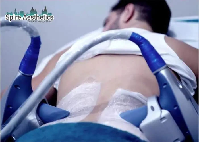 Man having fat freezing treatment done on love handles before a competitions Welford on Avon to create a sculpted look.