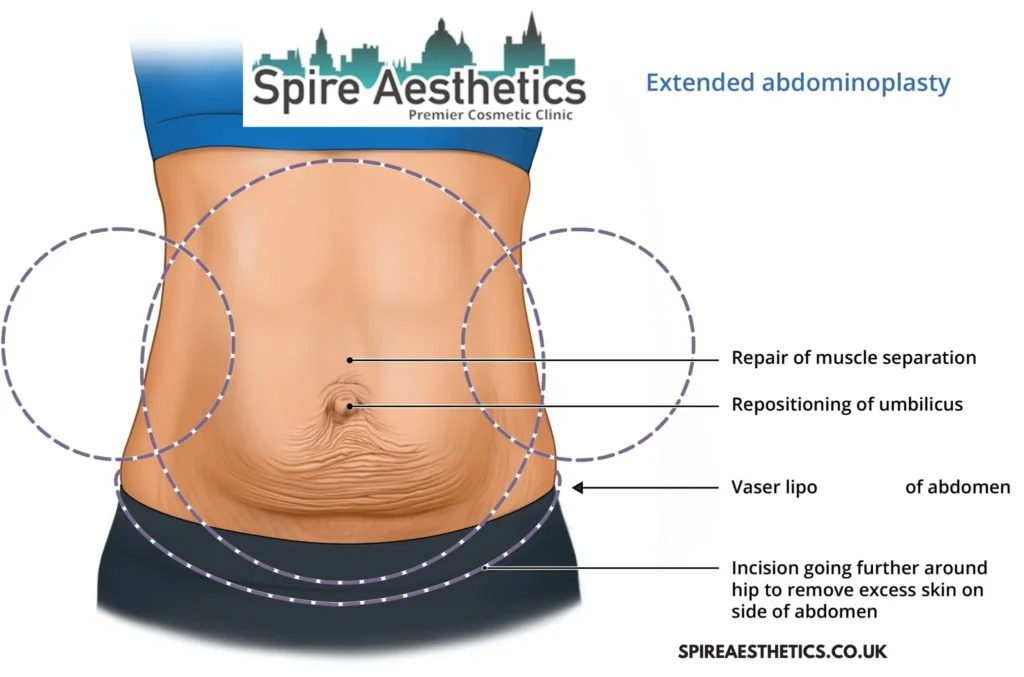 Understanding Loose Skin After Gastric Band Welford on Avon Surgery and HIFU Treatment