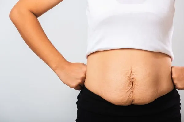 Image of a woman's stomach after weight loss with sagging skin following a gastric band Welford on Avon