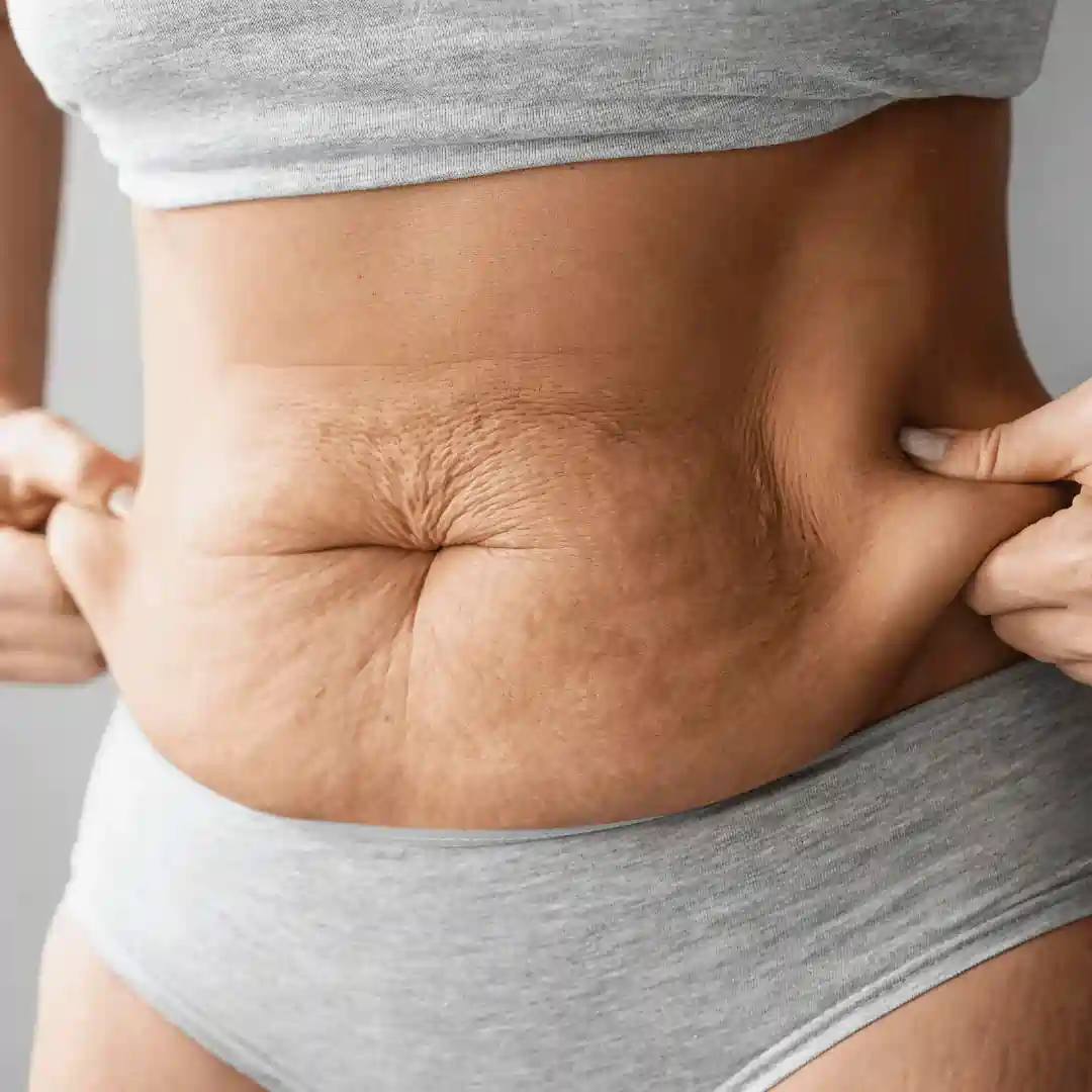 Is It Normal to Have Loose Skin After Pregnancy Welford on Avon?